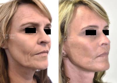 Facelift in London Before & After Results