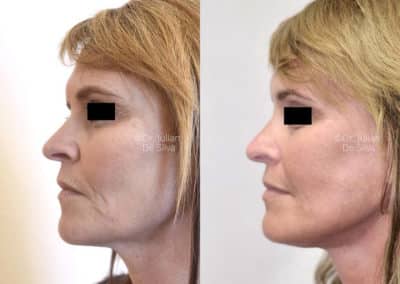 Facelift in London Before & After Results