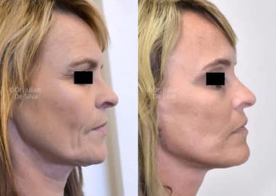 Facelift in London Before & After Results