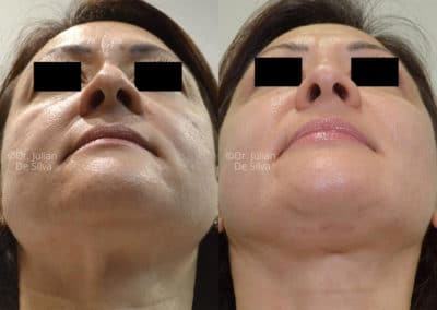 Facelift in London Before & After Results