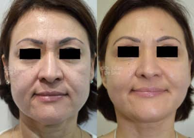 Facelift in London Before & After Results