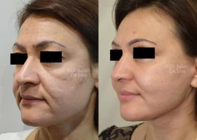 Facelift in London Before & After Results