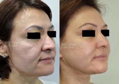 Facelift in London Before & After Results