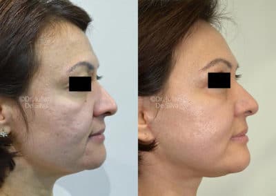 Facelift in London Before & After Results