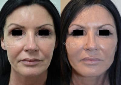 Facelift in London Before & After Results