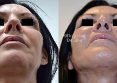 Facelift in London Before & After Results