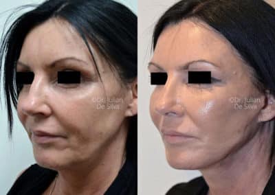 Facelift in London Before & After Results