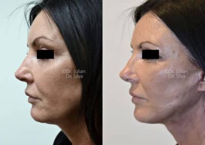 Facelift in London Before & After Results