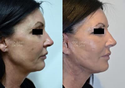 Facelift in London Before & After Results