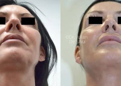 Facelift in London Before & After Results