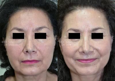 Facelift in London Before & After Results