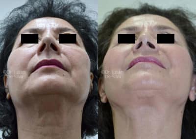 Facelift in London Before & After Results