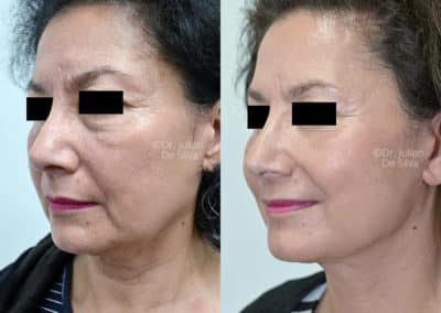 Facelift in London Before & After Results