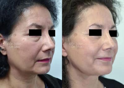 Facelift in London Before & After Results