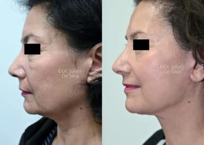 Facelift in London Before & After Results