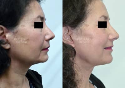 Facelift in London Before & After Results