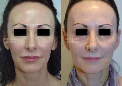 Facelift in London Before & After Results