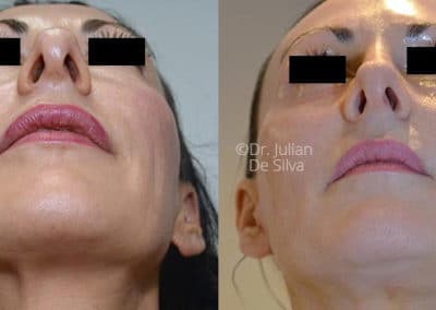 Facelift in London Before & After Results