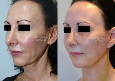 Facelift in London Before & After Results