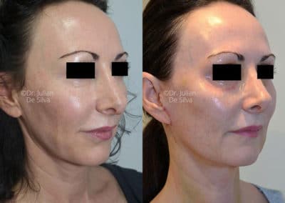 Facelift in London Before & After Results