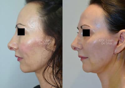 Facelift in London Before & After Results