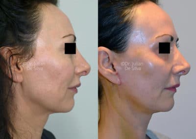 Facelift in London Before & After Results