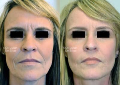 Facelift in London Before & After Results