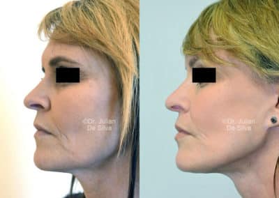 Facelift in London Before & After Results