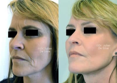 Facelift in London Before & After Results