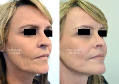 Facelift in London Before & After Results