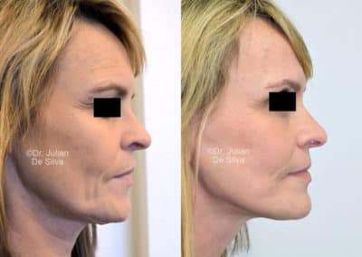 Facelift in London Before & After Results