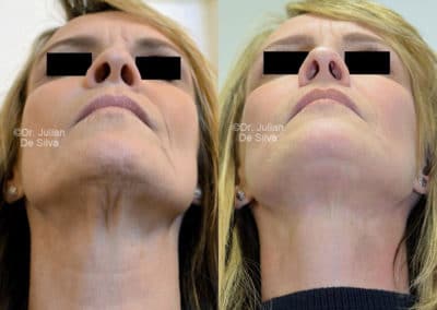 Facelift in London Before & After Results