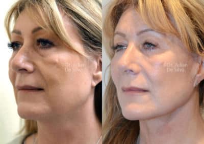 Facelift in London Before & After Results