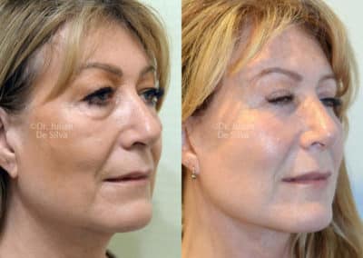 Facelift in London Before & After Results