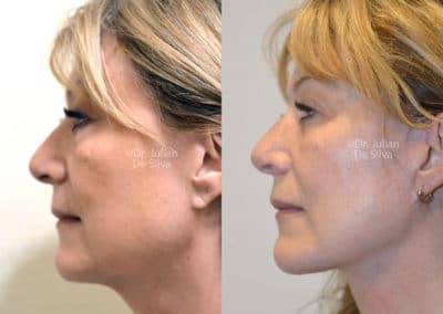 Facelift in London Before & After Results