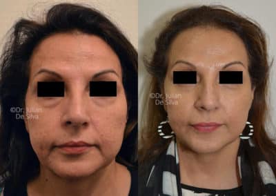 Facelift in London Before & After Results