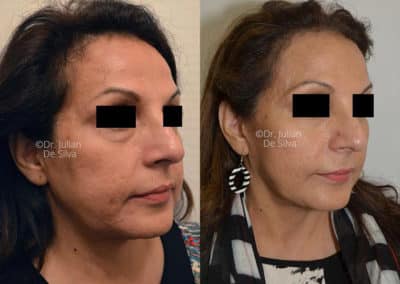 Facelift in London Before & After Results