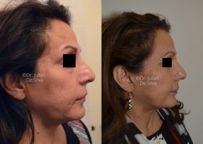 Facelift in London Before & After Results