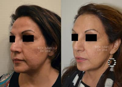 Facelift in London Before & After Results