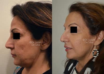 Facelift in London Before & After Results