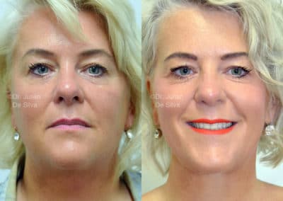 Facelift in London Before & After Results