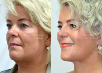 Facelift in London Before & After Results