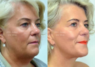 Facelift in London Before & After Results