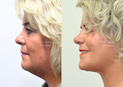 Facelift in London Before & After Results