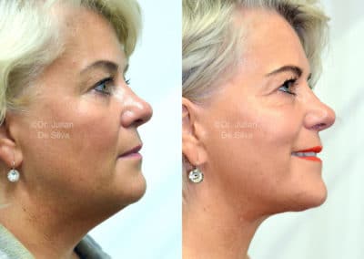 Facelift in London Before & After Results