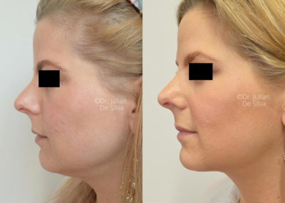 Facelift in London Before & After Results