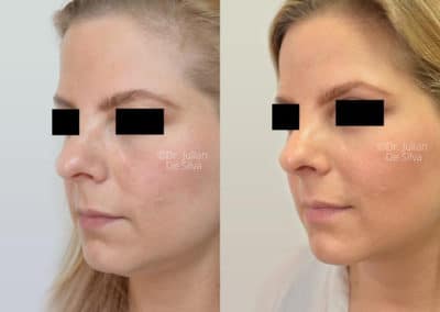 Facelift in London Before & After Results