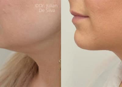 Facelift in London Before & After Results