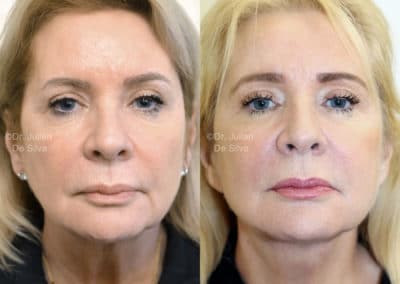 Facelift in London Before & After Results