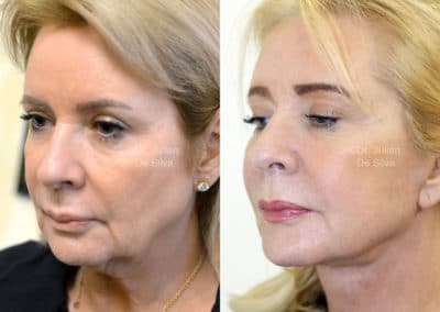 Facelift in London Before & After Results